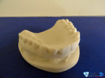 Dentaire — SLA 6 à 25 microns, issu d'un scanner